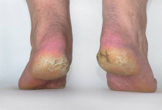 Cara Alami Mengatasi Tumit Kaki Pecah-Pecah