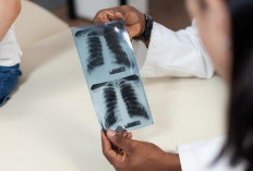 Dinkes Imbau Masyarakat Waspada TBC, Berikut Penangan Harus yang Dilakukan