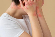 Dermatitis Seboroik: Penyebab, Gejala, dan Cara Mengatasinya