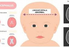 Dinsos Pastikan Telah Dampingi  Anak Penderita Hydrocephalus