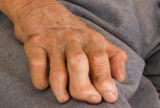 WNI Terlibat Kasus Kusta Pertama  di Rumania Setelah 44 Tahun, Kemenkes Lakukan Penelusuran