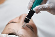 Microneedling: Manfaat dan Risiko yang Perlu Diketahui