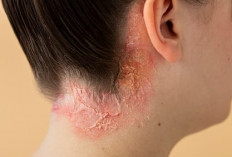 Cara Mengatasi Psoriasis di Kulit Kepala Secara Alami