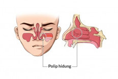 Polip Hidung: Gejala, Penyebab, dan Pilihan Pengobatan